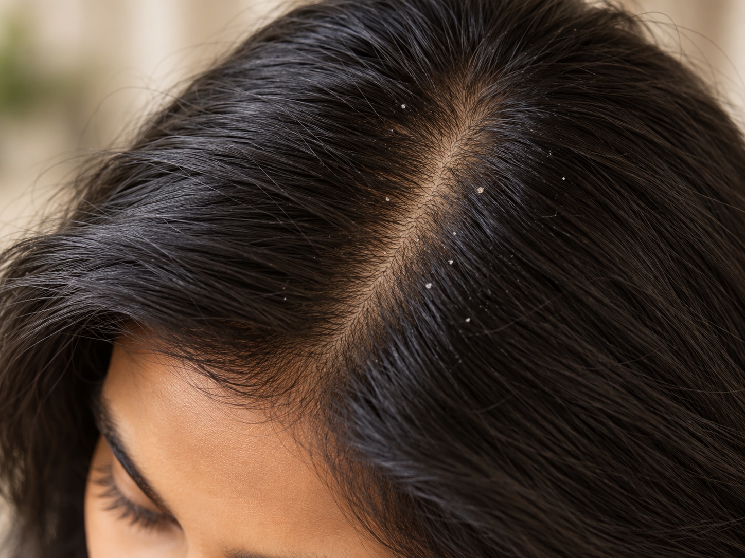 Dandruff hair or skin concern